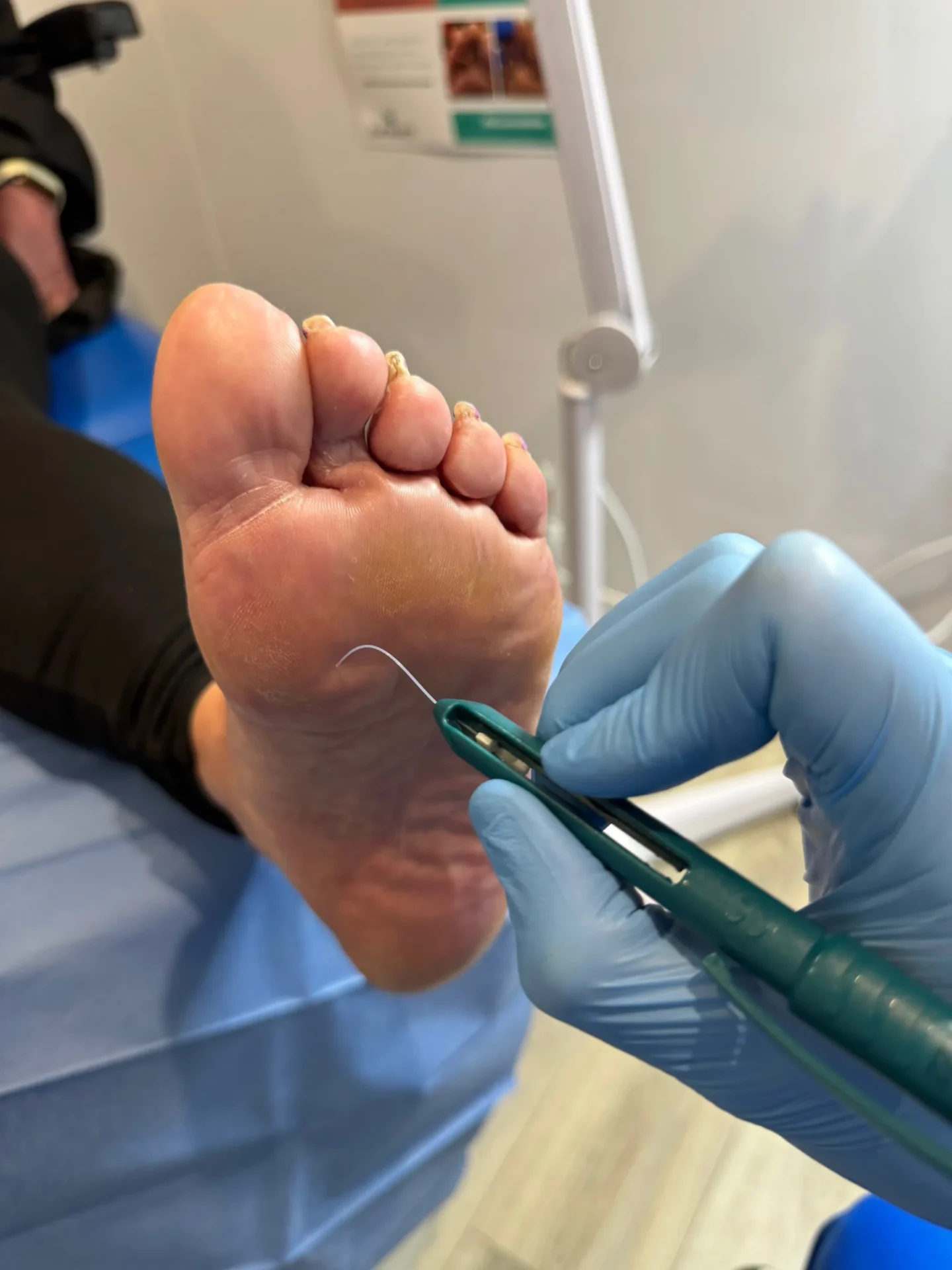 diabetic foot